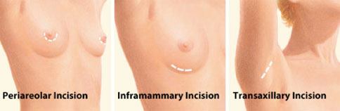 Breast augmentation incision locations