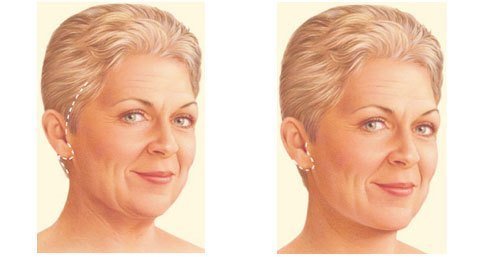 Facelift Incisions