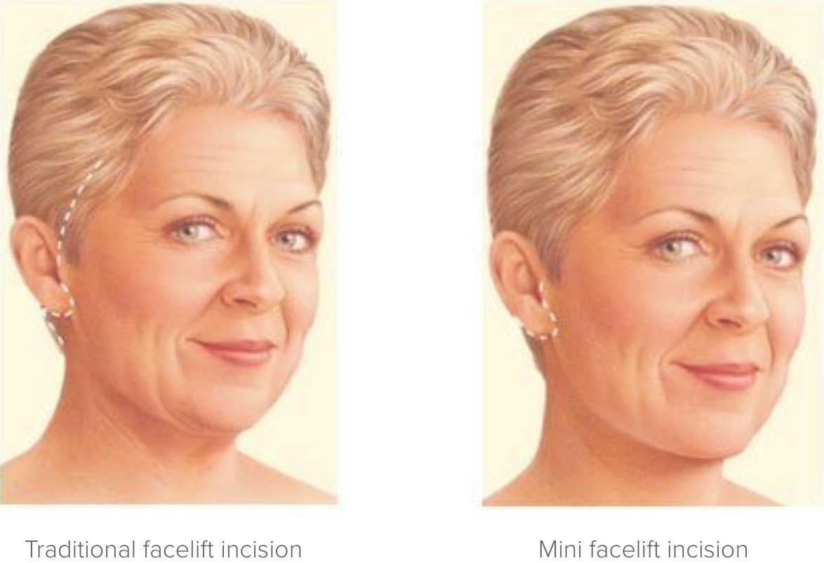 Facelift incision locations